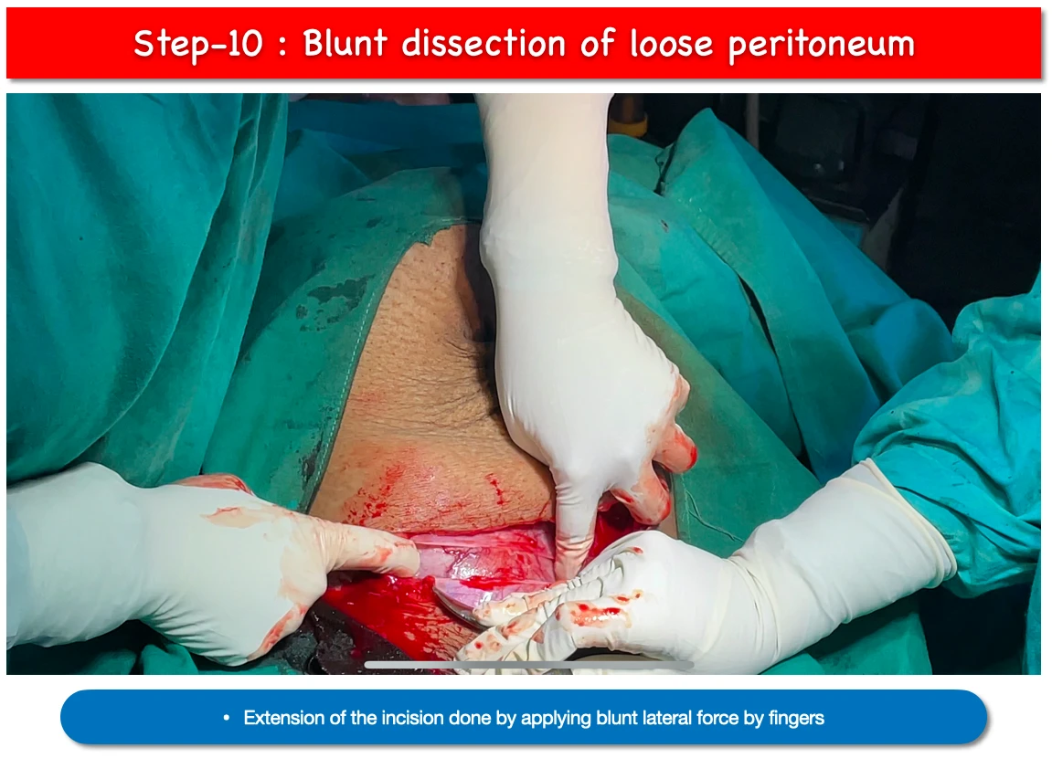 LSCS step-10